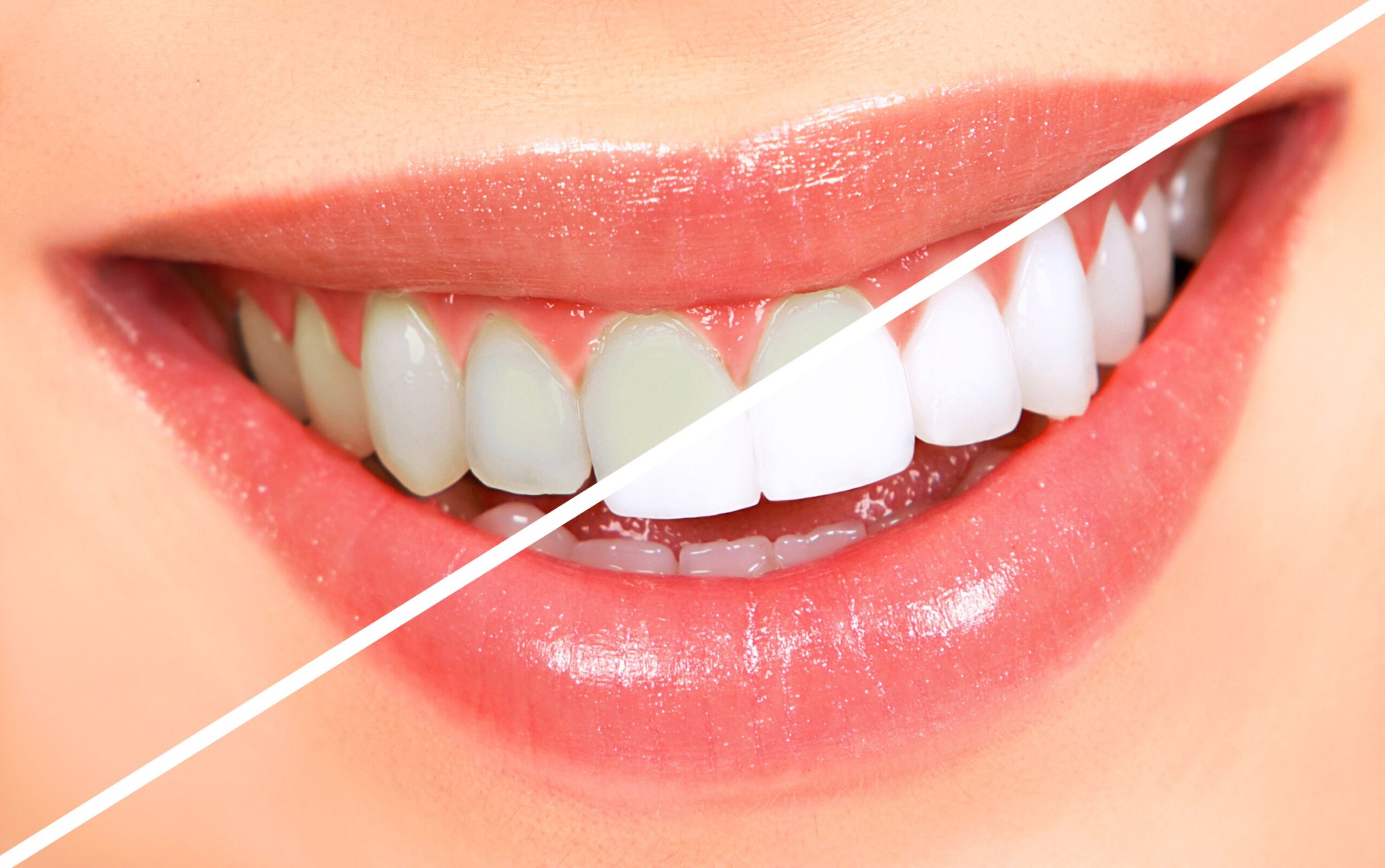 teeth whitening missiassuga 