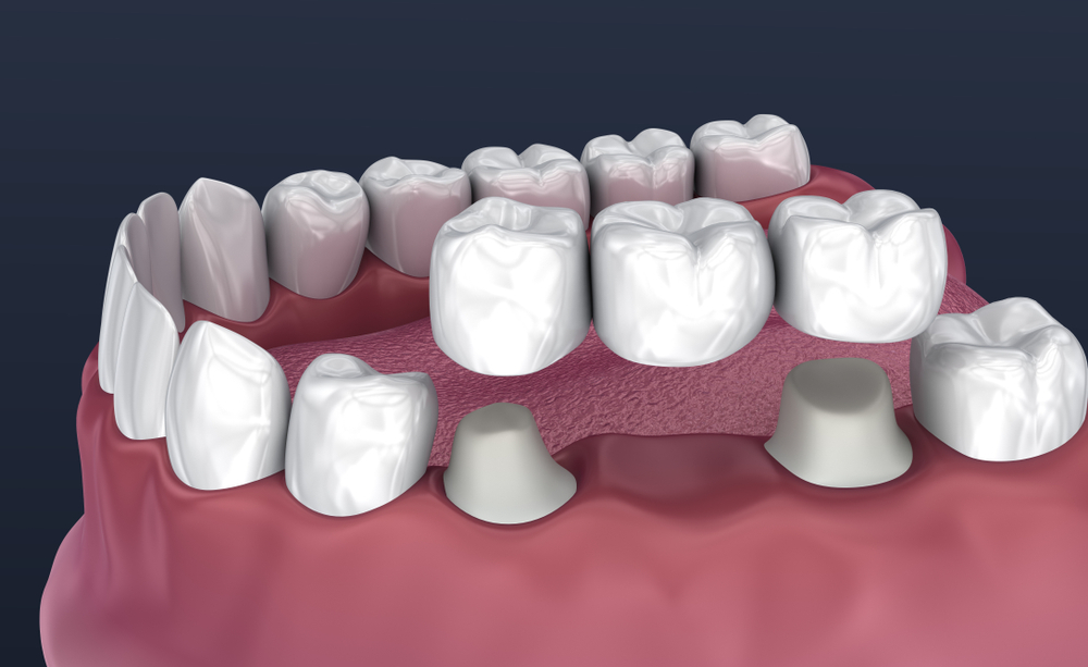 dental crown and bridges treatment in mississauga 